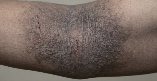 Eczema patches in antecubital fossae