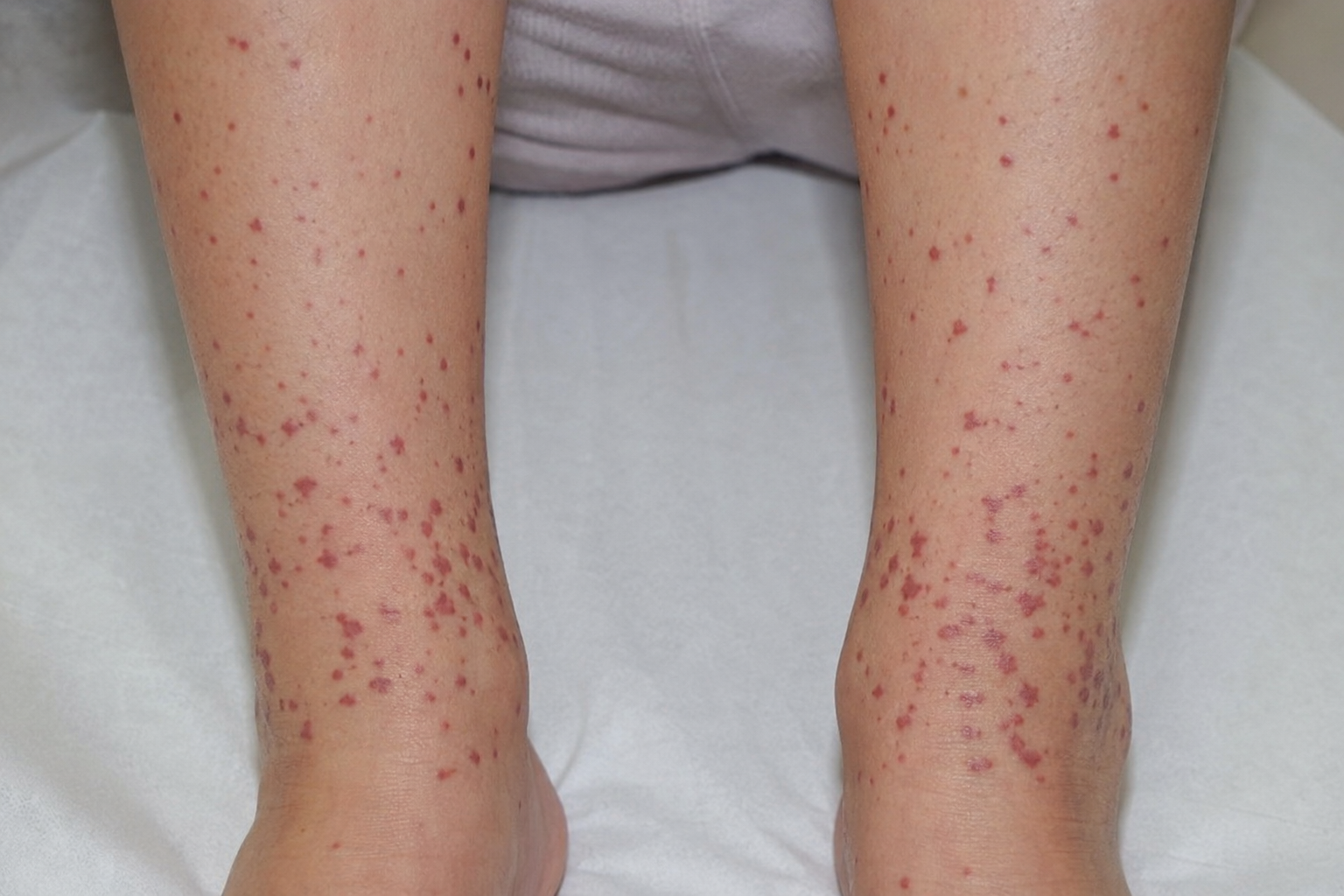 HSP purpuric rash on shins and ankles