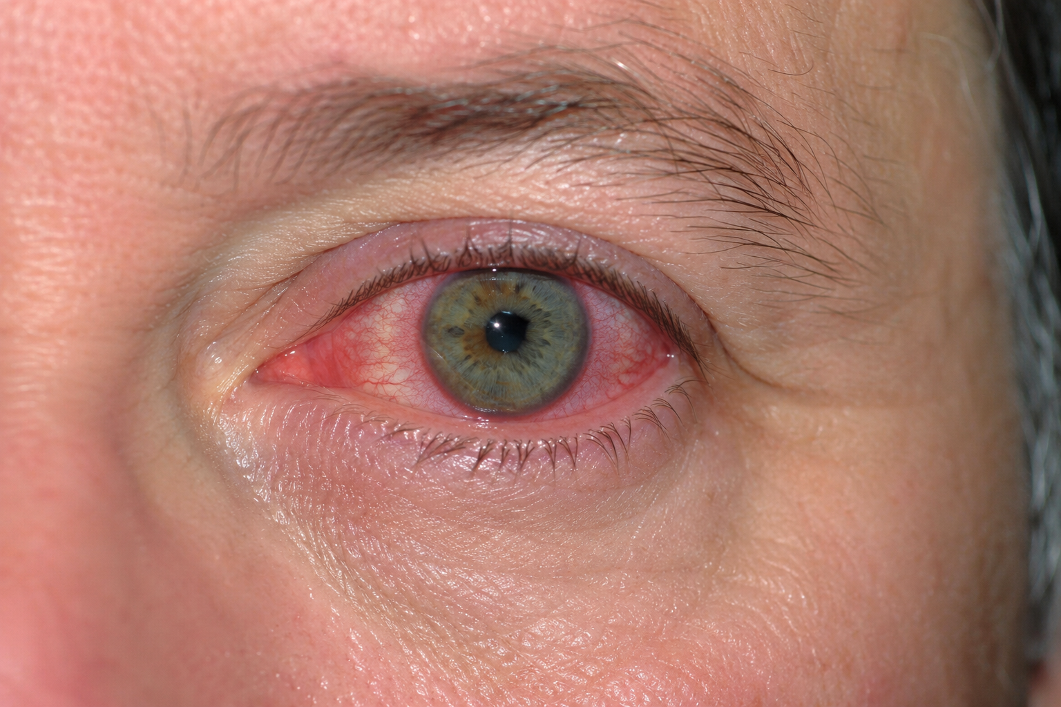 Uveitis — eye with ciliary flush and irregular pupil